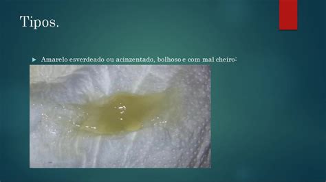 corrimento branco aquoso|Tipos de Corrimento Vaginal e o que Eles Dizem Sobre Sua Saúde